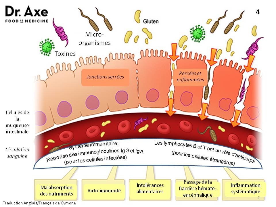 Schéma de la muqueuse intestinale perméable : jonctions serrées percées, passage de toxines et de micro-organismes vers la circulation sanguine